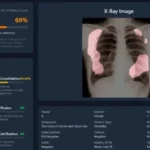 UGM Kembangkan Aplikasi Skrining TBC Berbasis AI Pertama di Indonesia